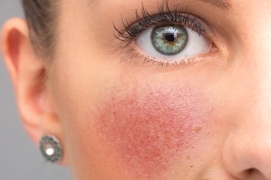 Rosacea: Steer Clear of these Foods for Calm Skin thumbnail