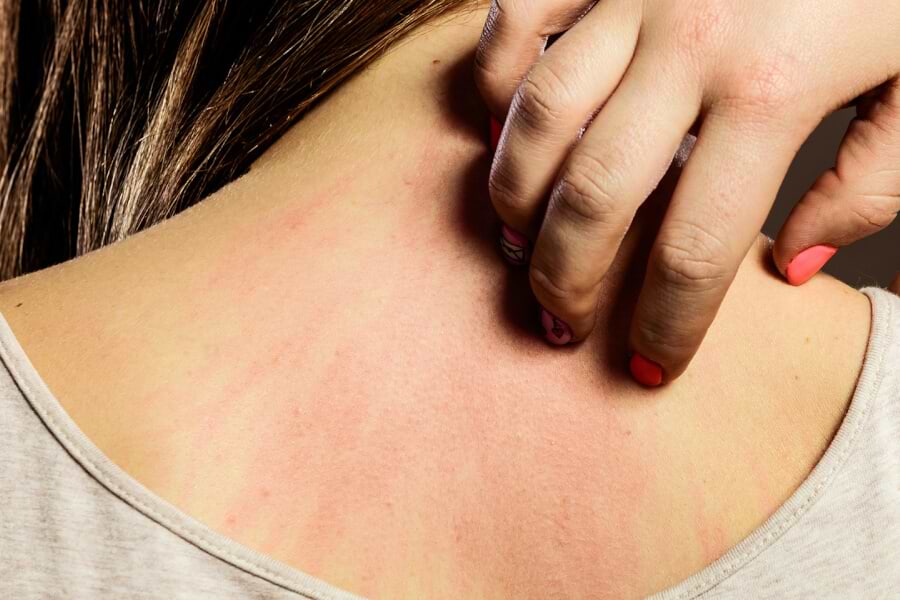 5 Natural Supplements to Fight Dry Itchy Skin thumbnail