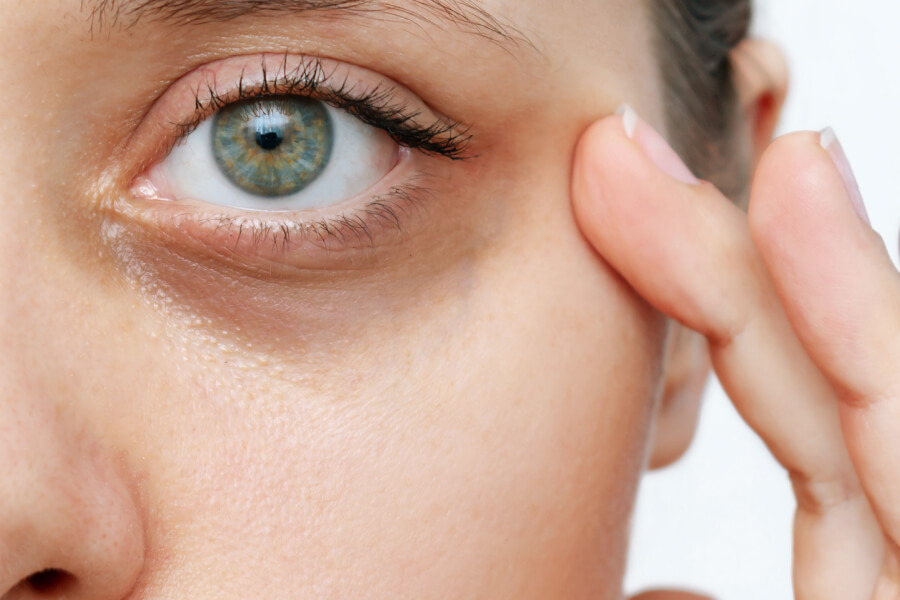 7 Causes of Dark Under-Eye Circles & How to Reduce Them thumbnail