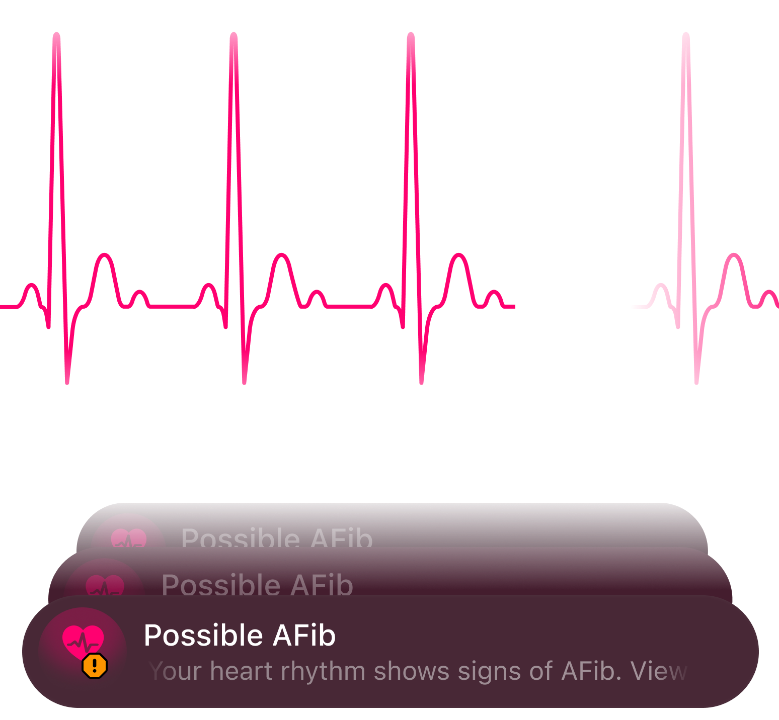 AFib検出