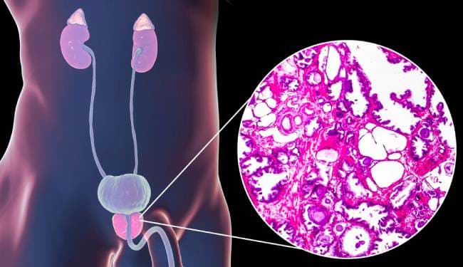 Benign-Prostatic-Hyperplasia