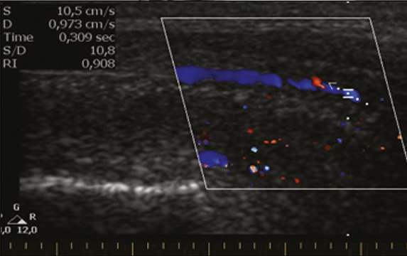 Penile Doppler